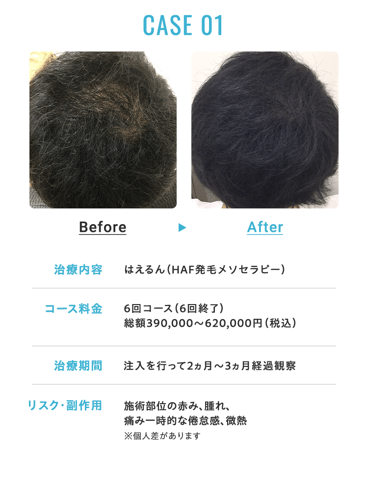 CASE 01 治療内容：HCE発毛メソセラピー コース料金：総額195,000円（税込）  モニター割引前390,000円（税込） ※モニター条件あり 治療期間：注入を行って2ヶ月経過観察 リスク・副作用：針先行為による僅かな痛み、ごく微量の出血、一時的な頭皮の違和感が出る可能性あり ※個人差があります