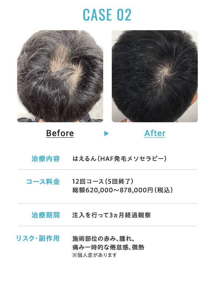 CASE 02 治療内容：HCE発毛メソセラピー コース料金：総額279,000円（税込） モニター割引前620,000円（税込） ※モニター条件あり 治療期間：注入を行って1ヶ月経過観察 リスク・副作用：針先行為による僅かな痛み、ごく微量の出血、一時的な頭皮の違和感が出る可能性あり ※個人差があります