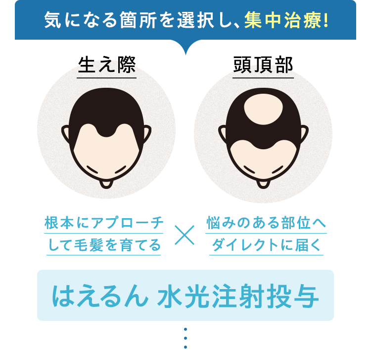気になる箇所を選択し、集中治療!根本にアプローチして毛髪を育てるX悩みのある部位へダイレクトに届くHCE水光注射投与