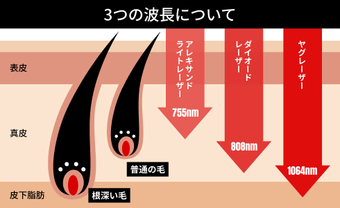 3つの波長（アレキサンドライト755nm、ダイオード808nm、YAG 1064nm）の到達深度の比較
