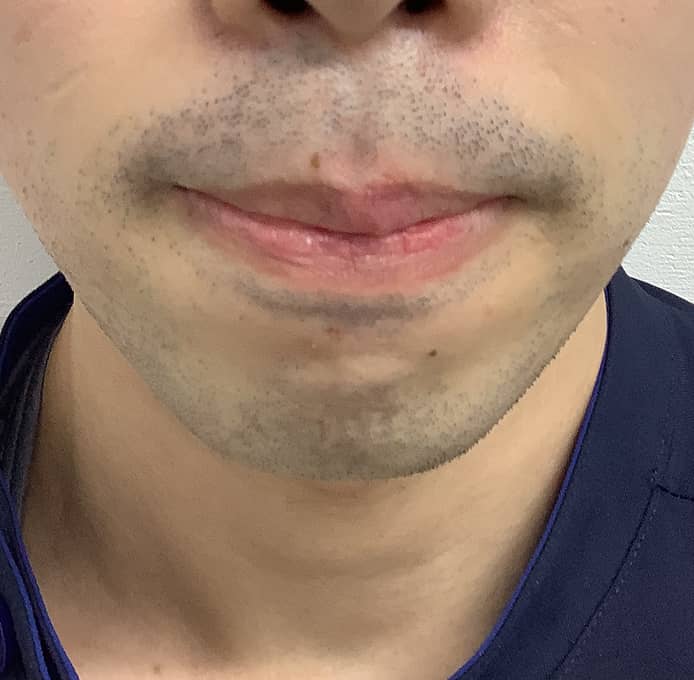 ヒゲ脱毛 BEFORE