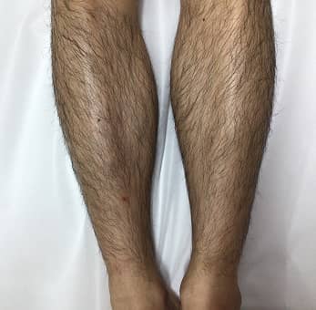 脚脱毛 BEFORE