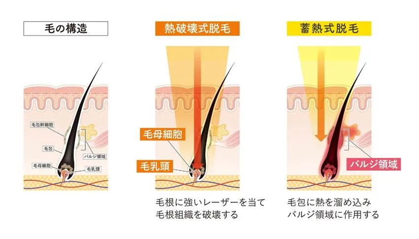 毛の構造と、熱破壊式脱毛と蓄熱式脱毛の違い